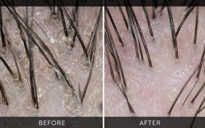 The Hidden Cause of Hair Fall: Diagnosing Scalp Buildup & The Aqua Spa Reset